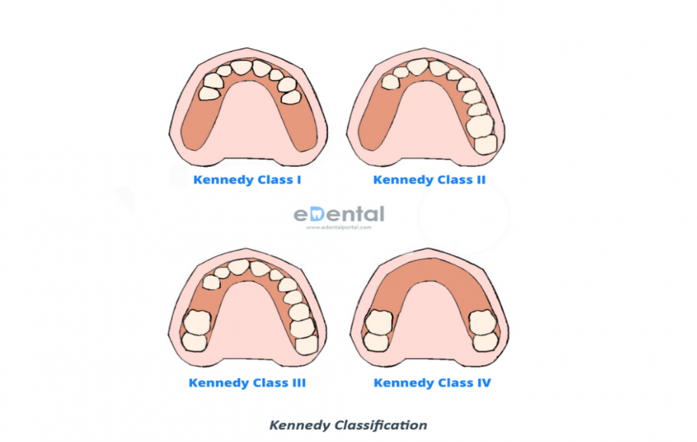 Kennedy Classification and Applegate's Rules in Removal Partial